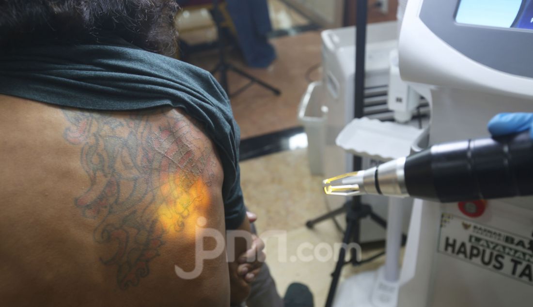 Petugas melakukan proses penghapusan tato menggunakan laser di Balai Kota, Jakarta, Selasa (11/3). Baznas Jakarta menggelar program layanan hapus tato Ramadan bagi masyarakat yang ingin berhijrah. Tahun ini ditargetkan menjangkau 700 peserta yang tersebar di wilayah Jakarta. - JPNN.com