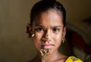 Kisah Pilu Sahana, 'Gadis Pohon' Pertama di Dunia - JPNN.com