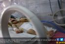 Operasi Langka Pemisahan Kepala Bayi Kembar Berhasil Dilakukan - JPNN.com