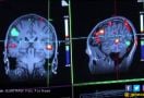 Kecerdasan Buatan Ternyata Bisa Memprediksi Penyakit Alzheimer 6 tahun lebih awal - JPNN.com