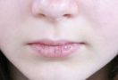 Kenali Penyebab Bibir Pecah-pecah dan Cara Mengobatinya - JPNN.com