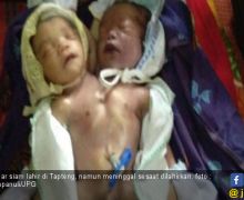 Bayi Kembar Siam Dempet Dada dan Perut Akhirnya Meninggal - JPNN.com