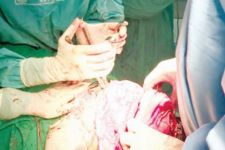 Orthognathic Surgery untuk Memperbaiki Rahang - JPNN.com