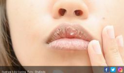 7 Penyebab Bibir Kering - JPNN.com