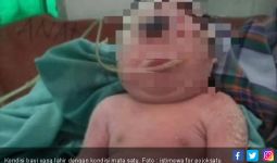 Bayi Terlahir dengan Hanya Mata Satu di Kening Itu Meninggal - JPNN.com
