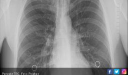 Waspada Sudah 7.007 Kasus Penderita TBC Ditemukan - JPNN.com