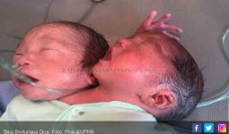 Bayi Berkepala Dua Lahir di Kalimantan Selatan - JPNN.com