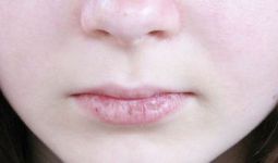 Kenali Penyebab Bibir Pecah-pecah dan Cara Mengobatinya - JPNN.com