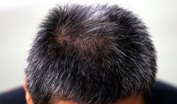 Mengenal Alopecia Areata dan 5 Cara Mengatasi Kerontokan Rambut Akibat Penyakit Ini - JPNN.com