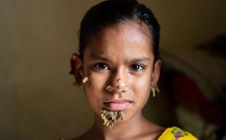 Kisah Pilu Sahana, 'Gadis Pohon' Pertama di Dunia - JPNN.com