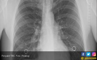 Segera Lakukan Deteksi Dini Penyakit TBC ! - JPNN.com