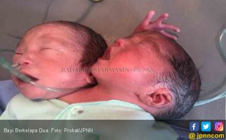 Bayi Berkepala Dua Lahir di Kalimantan Selatan - JPNN.com