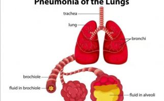 Pneumonia, Penyakit Pernapasan yang Sering Dianggap Sebagai Flu Biasa - JPNN.com