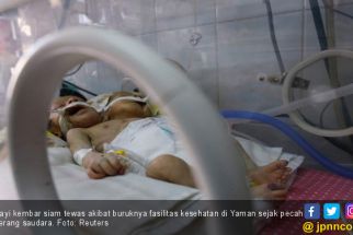 RSUP Haji Adam Malik Pertimbangkan Kemungkinan Pemisahan Bayi Kembar Siam asal Asahan - JPNN.com Sumut