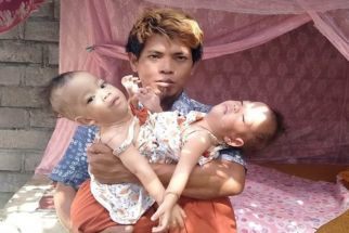 Operasi Bayi Kembar Asal Selong NTB Tertunda: Covid-19 di Jawa Jadi Kambing Hitam - JPNN.com Bali