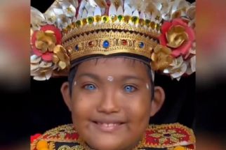 Bocah Buleleng Bermata Biru Bikin Heboh, Dokter RS Mata Bali Mandara Beri Penjelasan - JPNN.com Bali