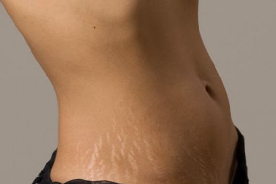 Hindari Stretch Mark dengan 4 Langkah Mudah - JPNN.COM