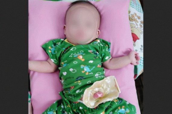 Tolong! Bayi Muhamad Arpan Butuh Bantuan, Lahir Tanpa Anus - JPNN.COM