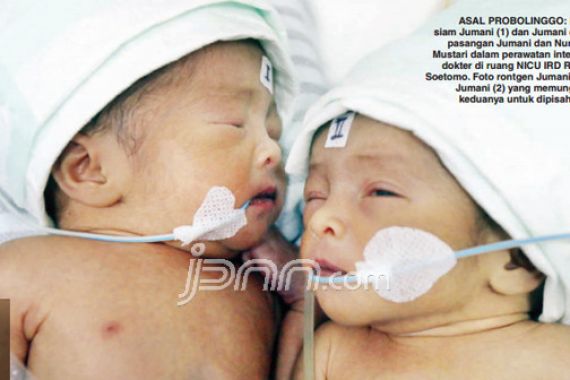 Suara Rengekan Bayi Kembar Siam Bikin Hati Miris - JPNN.COM