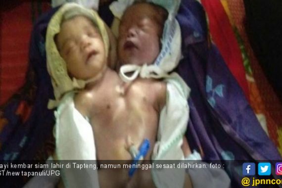 Bayi Kembar Siam Dempet Dada dan Perut Akhirnya Meninggal - JPNN.COM