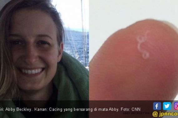 Ngeri! 14 Cacing Bersarang di Mata Cewek Cantik Ini - JPNN.COM