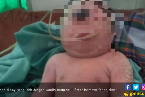 Bayi Ini Lahir dengan Hanya Satu Mata di Keningnya - JPNN.COM