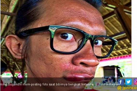 Unggah Foto Bibir Bengkak, Aming Sindir Ratna Sarumpaet? - JPNN.COM