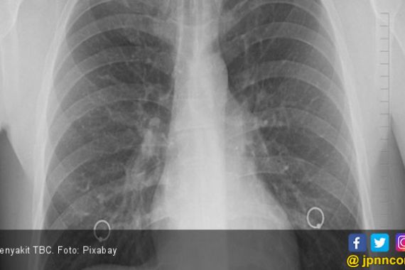 Waspada, Penyakit TBC Menghantui Warga Indonesia - JPNN.COM