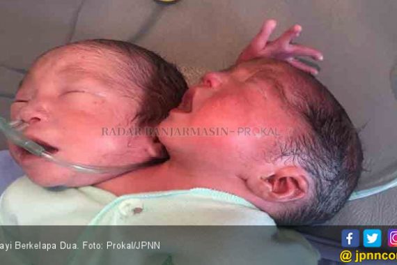 Bayi Berkepala Dua Lahir di Kalimantan Selatan - JPNN.COM