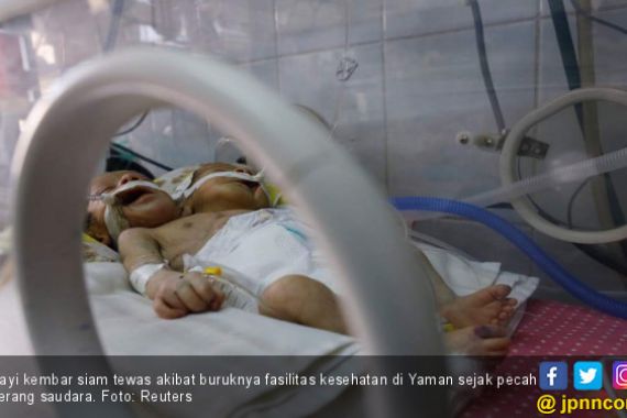 Miris, Bayi Kembar Siam Jadi Korban Perang Yaman - JPNN.COM