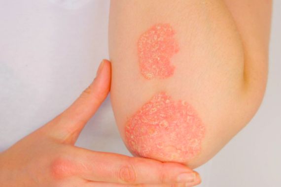 Komplikasi Psoriasis Bisa Berakibat Fatal - JPNN.COM