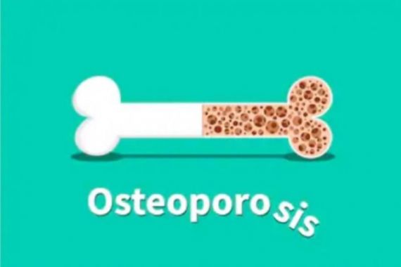 6 Cara Terbaik Menghindari Tulang Keropos Akibat Osteoporosis - JPNN.COM