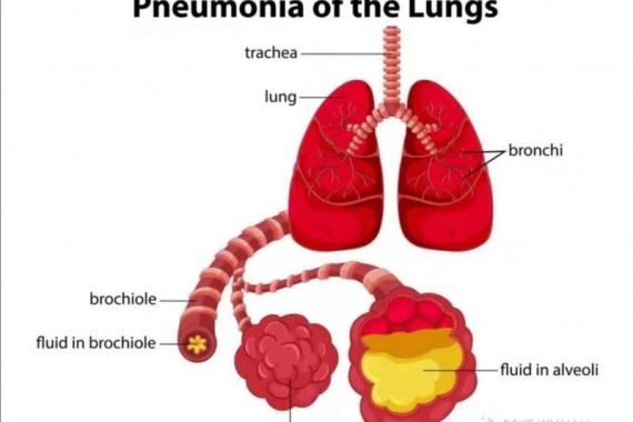 Pneumonia, Penyakit Pernapasan yang Sering Dianggap Sebagai Flu Biasa - JPNN.COM