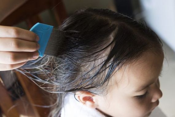 Gadis 4 Tahun ini Nyaris Meninggal Akibat Infeksi Kutu Rambut, Jangan Dianggap Remeh - JPNN.COM