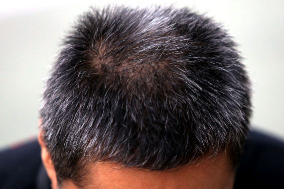 Mengenal Alopecia Areata dan 5 Cara Mengatasi Kerontokan Rambut Akibat Penyakit Ini - JPNN.COM