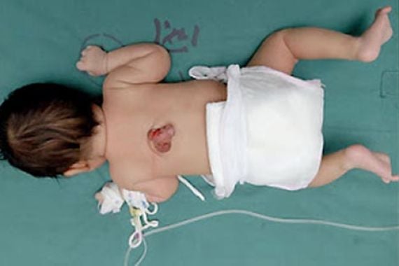 Bayi Memiliki 2 Kemaluan, 1 Normal, 1 di Punggung - JPNN.COM