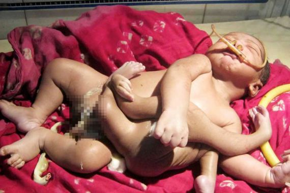Dianggap Titisan Dewa Brahma, Bayi di India Lahir dengan 4 Kaki dan 4 Lengan - JPNN.COM