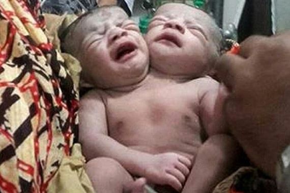 Lihat nih, Bayi Dua Kepala Lahir Di Bangladesh - JPNN.COM