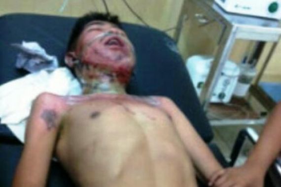 Pemuda Dibakar OTK, Kondisinya Kritis, Ini Fotonya - JPNN.COM