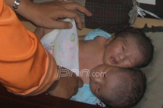 Bayi Laki-laki ini Terlahir Berkepala Dua - JPNN.COM