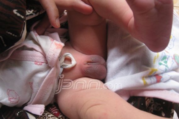 Bayi Lahir Tanpa Alat Kelamin dan Satu buah Zakar - JPNN.COM