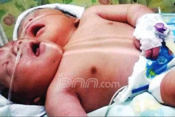 Detik-Detik Meninggalnya Bayi Kembar Siam Berkepala Dua - JPNN.COM