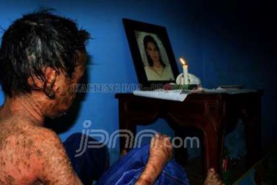 Kisah Pilu Bocah Bersisik Mirip Ular Asal Kalimantan, Bikin Nangis - JPNN.COM